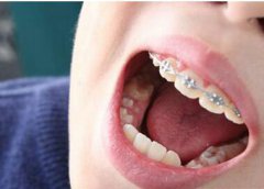 兒童有三個矯牙的「黃金時期」