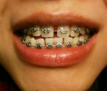 同大家詳細介紹下珠海牙齒矯正費用幾多