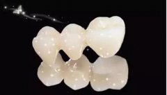 全瓷牙和烤瓷牙邊個好？