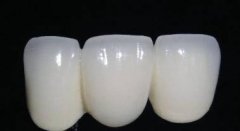 做全瓷牙能用幾耐呢？