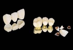 全瓷牙的壽命與邊D因素有關？