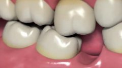 大陸植牙推薦——患者share經歷