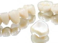 大陸全瓷牙套價錢好貴，係咪真嘅