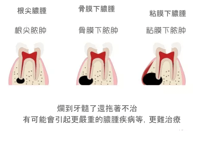 牙痛快速止痛方法