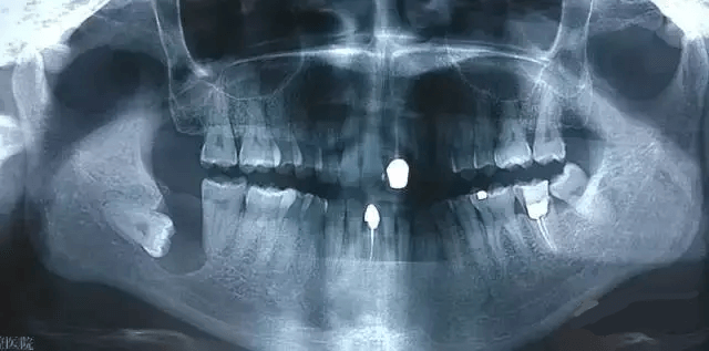 牙痛快速止痛方法