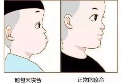 乳牙地包天該怎麼預防?