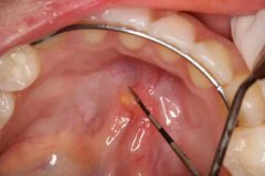 如果您吃飯時嘴巴內突然疼痛，需要注意唾液腺