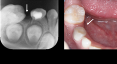 乳牙提前脫落了怎麼辦？