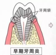 关于牙周炎,看这一篇就够了