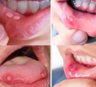 讓人無可奈何的口腔潰瘍，居家期間如何應對？