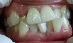 你的牙齒健康嗎？我國90%成年人患牙周炎