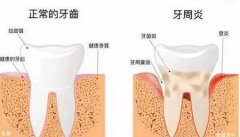 牙周病置之不理？！當心變成“無齒之徒”！
