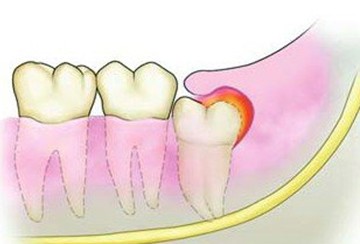 五種常見牙痛原因