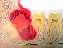 長智齒牙疼如何治療