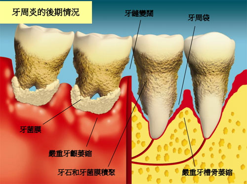 什麼原因會引致劇烈牙痛？