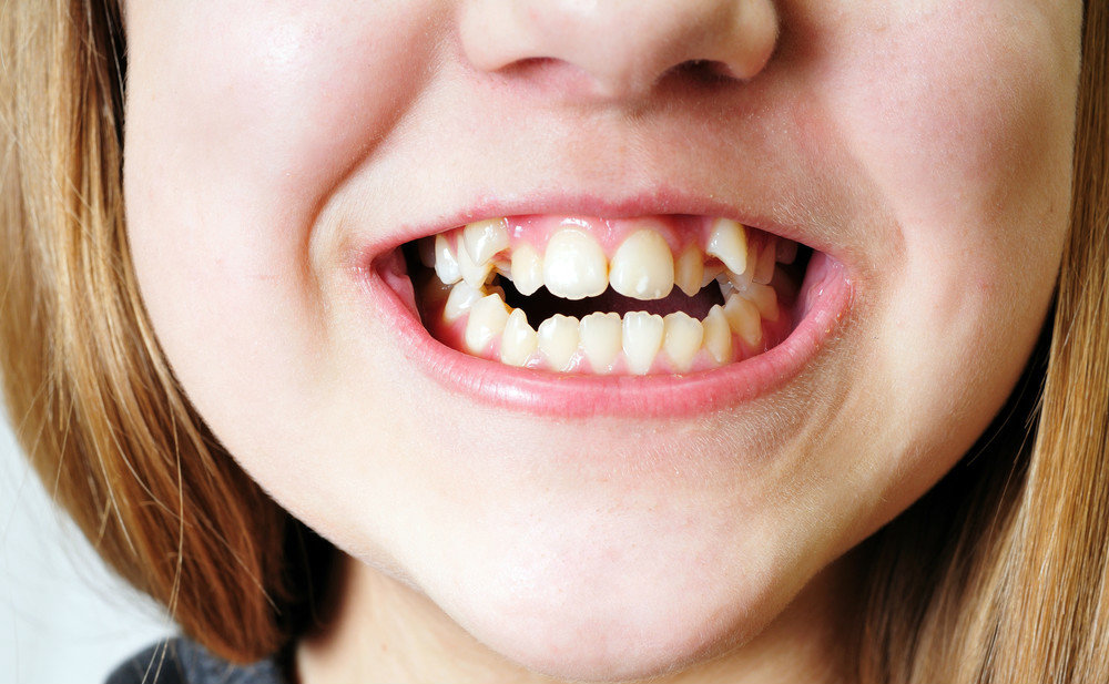 珠海兒童齲齒牙痛怎麼辦？