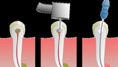 澳門杜牙根費用介紹，杜牙根牙冠價錢一覽