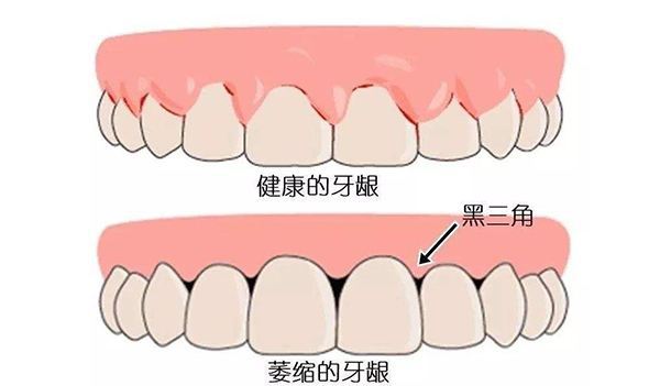 什麼是牙齦萎縮