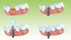 澳門種植牙價格介紹