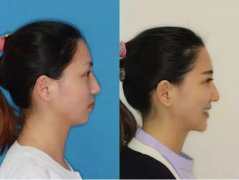 大家都說拔牙矯正有害健康，這是真的嗎？