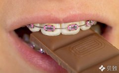 牙套黨們如何愉快吃吃吃？