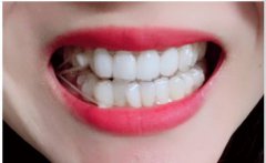 牙套上橡皮筋的N個秘密